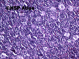 5. Klasyczny Chłoniak Hodgkina - bogaty w limfocyty (lymphocyte-rich, LR), 20x