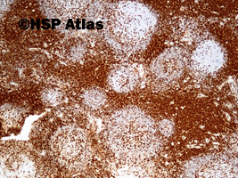13. Lymph node, CD 5 in T cells, 4x