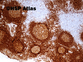 15. Węzeł chłonny, CD 79 w komórkach B strefy płaszcza (silnie) i ośrodków rozmnażania (słabiej) oraz w plazmocytach, 4x