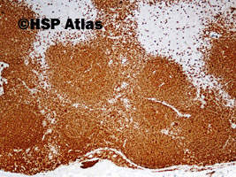 16. Węzeł chłonny, CD20 w dojrzałych komórkach B (ale nie komórkach plazmatycznych) ośrodków rozmnażania (silnie) i płaszcza (słabiej), 4x
