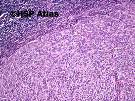1. Melanoma metastasis to lymph node, 10x