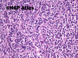 2. Przerzut czerniaka do węzła chłonnego (melanoma metastasis to lymph node), 20x