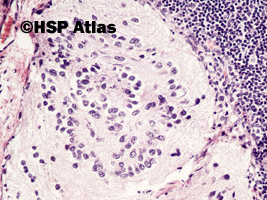3. Przerzut neuroblastoma do węzła chłonnego (neuroblastoma metastasis to lymph node), 20x