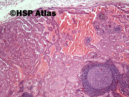 1. Przerzut raka brodawkowatego tarczycy do węzła chłonnego (thyroid papillary carcinoma metastasis to lymph node), 4x