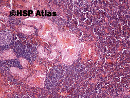 2. Przerzut raka brodawkowatego tarczycy do węzła chłonnego (thyroid papillary carcinoma metastasis to lymph node), 10x
