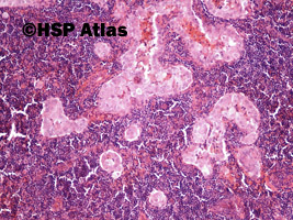 3. Przerzut raka brodawkowatego tarczycy do węzła chłonnego (thyroid papillary carcinoma metastasis to lymph node), 10x