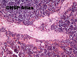 4. Przerzut raka brodawkowatego tarczycy do węzła chłonnego (thyroid papillary carcinoma metastasis to lymph node), 20x