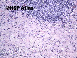 2. Rhabdomyosarcoma metastasis to lymph node, 10x