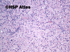 3. Rhabdomyosarcoma metastasis to lymph node, 10x