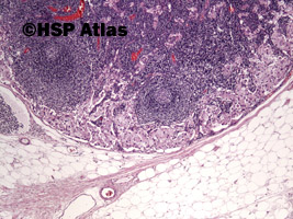 1. Signet ring cell carcinoma metastasis to lymph node, 4x