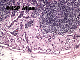 2. Signet ring cell carcinoma metastasis to lymph node, 10x