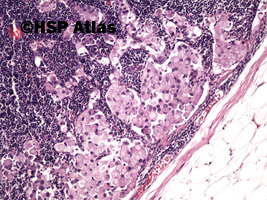 3. Przerzut raka sygnetowatego do węzła chłonnego (signet ring cell carcinoma metastasis to lymph node), 10x