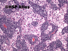 4. Przerzut raka sygnetowatego do węzła chłonnego (signet ring cell carcinoma metastasis to lymph node), 10x