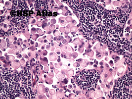 5. Przerzut raka sygnetowatego do węzła chłonnego (signet ring cell carcinoma metastasis to lymph node), 20x