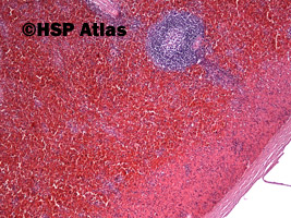1. Sferocytoza wrodzona (hereditary spherocytosis), mężczyzna, 16 lat, 4x
