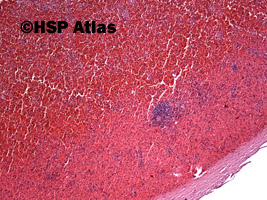 2. Hereditary spherocytosis, 4x