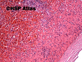 4. Sferocytoza wrodzona (hereditary spherocytosis), 10x