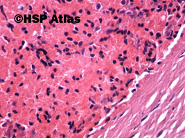 6. Sferocytoza wrodzona - cienie erytrocytów (hereditary spherocytosis - ghost red blood cells), 40x