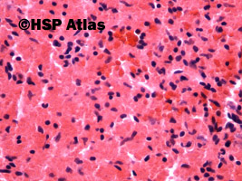 7. Sferocytoza wrodzona - cienie erytrocytów oraz prawidłowe erytrocyty (hereditary spherocytosis - ghost and normal red blood cells), 40x