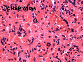 8. Hereditary spherocytosis - ghost and normal red blood cells, 40x