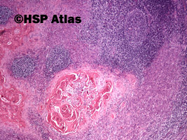 2. Przerzut raka płaskonabłonkowego do węzła chłonnego (squamous cell carcinoma metastasis to lymph node), 4x