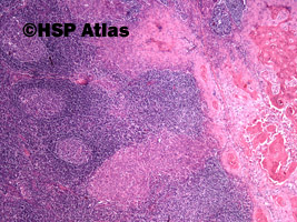 3. Przerzut raka płaskonabłonkowego do węzła chłonnego (squamous cell carcinoma metastasis to lymph node), 4x