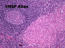 4. Squamous cell carcinoma metastasis to lymph node, 10x