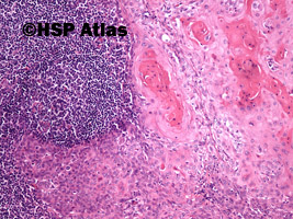 5. Przerzut raka płaskonabłonkowego do węzła chłonnego (squamous cell carcinoma metastasis to lymph node), 10x
