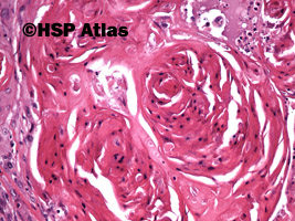 6. Przerzut raka płaskonabłonkowego do węzła chłonnego (squamous cell carcinoma metastasis to lymph node), 20x