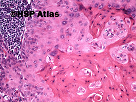 7. Przerzut raka płaskonabłonkowego do węzła chłonnego (squamous cell carcinoma metastasis to lymph node), 20x