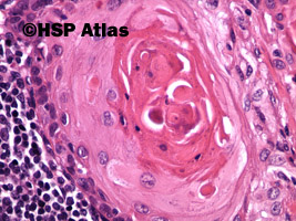 8. Przerzut raka płaskonabłonkowego do węzła chłonnego - perła rogowa (squamous cell carcinoma metastasis to lymph node - keratin pearl), 40x