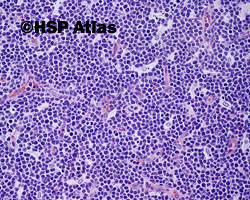 2. Ostra białaczka limfoblastyczna T - komórkowa (T - cell acute lymphoblastic leukemia)