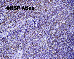 3. Ostra białaczka limfoblastyczna T - komórkowa (T - cell acute lymphoblastic leukemia), CD99