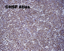 4. T - cell acute lymphoblastic leukemia, TdT