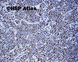 5. T - cell acute lymphoblastic leukemia, Ki-67