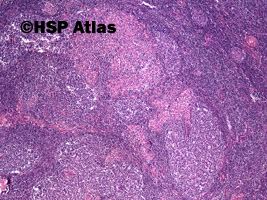 1. Toksoplazmoza - węzeł chłonny (Toxoplasmosis - lymph node), 4x