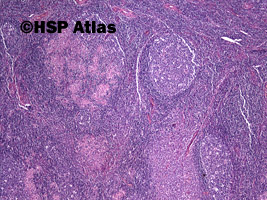 2. Toksoplazmoza - węzeł chłonny (Toxoplasmosis - lymph node), 4x