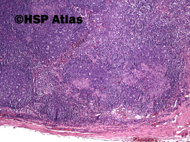 3. Toxoplasmosis - lymph node, 4x