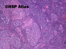 4. Toxoplasmosis - lymph node, 4x