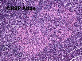 5. Toksoplazmoza - węzeł chłonny (Toxoplasmosis - lymph node), 10x