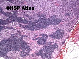 2. Przerzut raka urotelialnego (urothelial carcinoma metastasis to lymph node), 4x