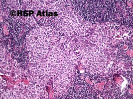 3. Przerzut raka urotelialnego (urothelial carcinoma metastasis to lymph node), 10x