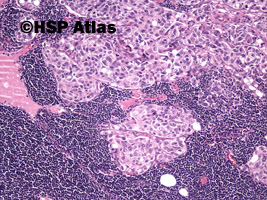 4. Urothelial carcinoma metastasis to lymph node, 10x