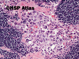 5. Przerzut raka urotelialnego (urothelial carcinoma metastasis to lymph node), 20x