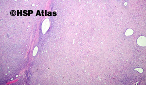 1. Gruczolakowłókniak jasnokomórkowy (Clear cell adenofibroma)