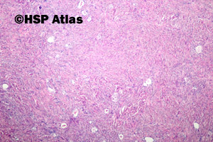 2. Gruczolakowłókniak jasnokomórkowy (Clear cell adenofibroma)