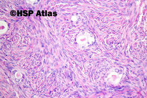 3. Gruczolakowłókniak jasnokomórkowy (Clear cell adenofibroma)