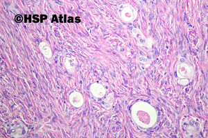 4. Gruczolakowłókniak jasnokomórkowy (Clear cell adenofibroma)