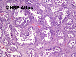 1. Rozrost gruczołowy złożony z atypią (complex endometrial hyperplasia with atypia), 4x