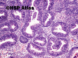 3. Rozrost gruczołowy złożony z atypią (complex endometrial hyperplasia with atypia), 10x